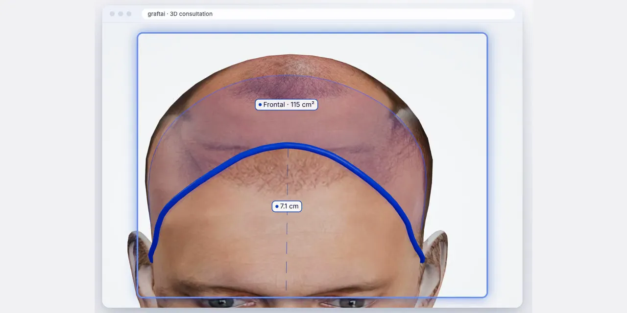A hairline drawn on the 3D head, with the grafts it needs estimated